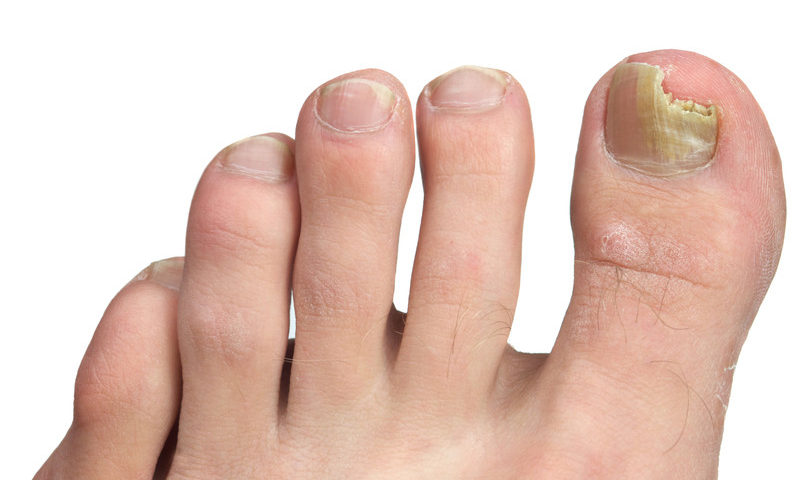 How To Treat (And Prevent) Ingrown Toenails – Canadian Podiatric Medical Association How To Treat (And Prevent) Ingrown Toenails – Canadian Podiatric Medical Association