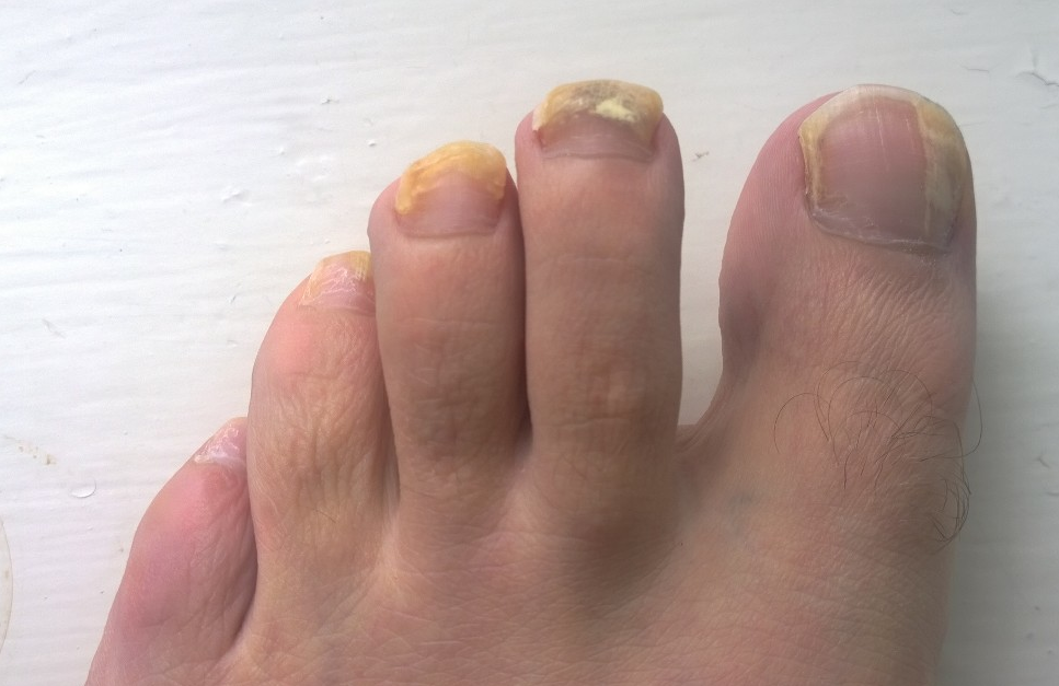 fungal-nail